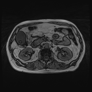 Acute cholecystitis (Radiopaedia 72392-82923 Axial T1 out-of-phase 64).jpg
