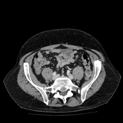Acute cholecystitis and incidental left sided IVC (Radiopaedia 49352-54459 Axial C+ portal venous phase 110).jpg