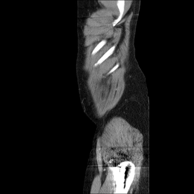 Acute cholecystitis and incidental left sided IVC (Radiopaedia 49352-54459 Sagittal C+ portal venous phase 84).jpg