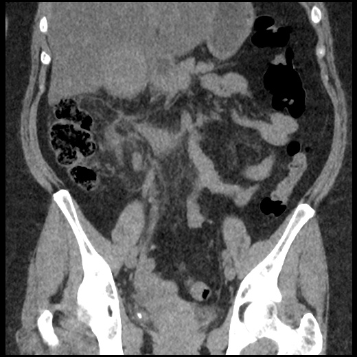 Acute cholecystitis and ureteric colic (Radiopaedia 42330-45444 Coronal prone 50).jpg