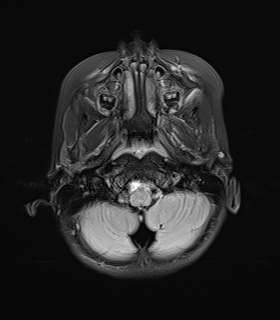 File:Acute disseminating encephalomyelitis with bilateral optic neuritis (Radiopaedia 79676-92886 Axial FLAIR 4).jpg