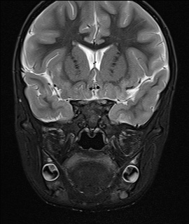 File:Acute disseminating encephalomyelitis with bilateral optic neuritis (Radiopaedia 79676-92886 Coronal STIR 14).jpg