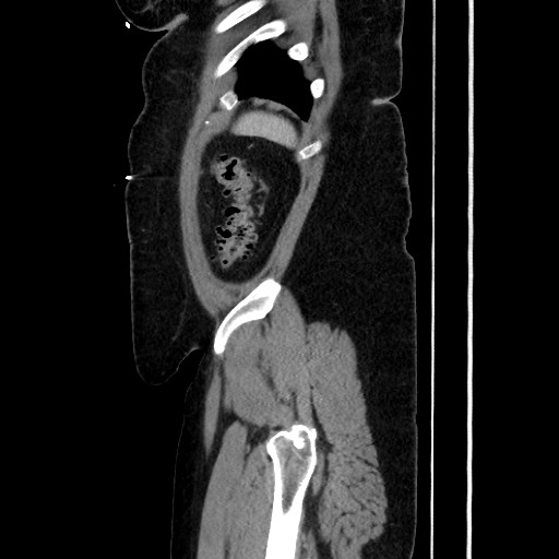 Acute diverticulitis - transverse colon (Radiopaedia 87063-103327 Sagittal C+ portal venous phase 187).jpg