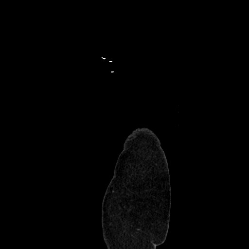 Acute diverticulitis - transverse colon (Radiopaedia 87063-103327 Sagittal C+ portal venous phase 236).jpg