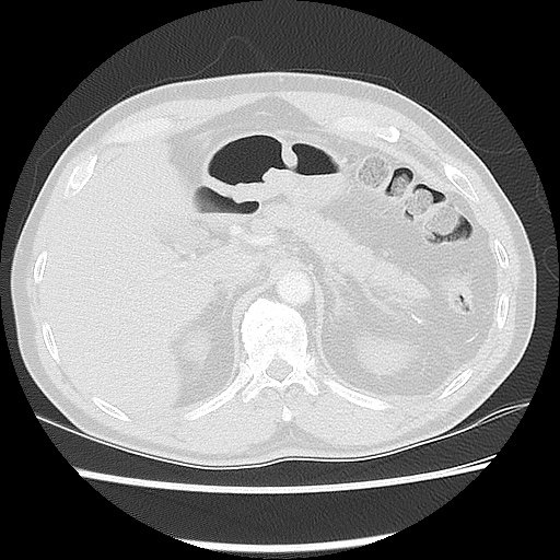 Acute epicardial fat necrosis (Radiopaedia 42327-45440 Axial lung window 55).jpg