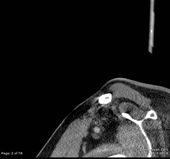 Acute epiglottitis (Radiopaedia 54375-60590 Sagittal C+ arterial phase 2).jpg