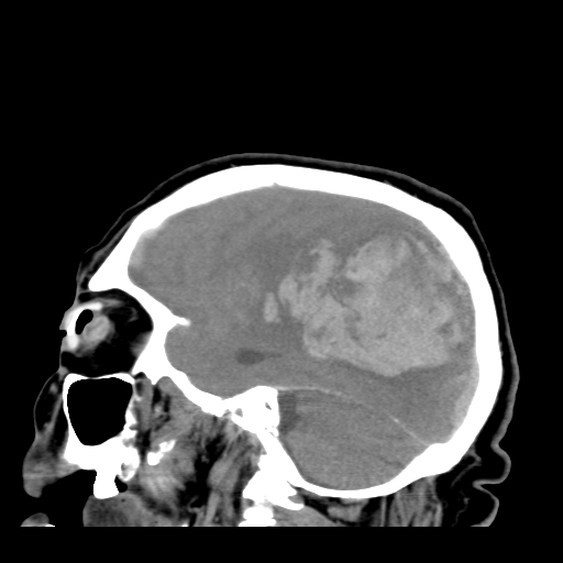 File:Acute hemorrhagic stroke (Radiopaedia 17507-17223 Sagittal non-contrast 13).jpg
