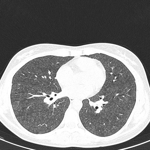 File:Acute hypersensitivity pneumonitis (Radiopaedia 85293-100870 Axial lung window 69).jpg
