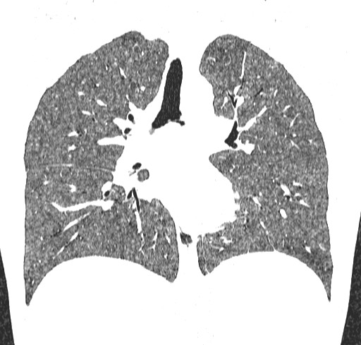 Acute hypersensitivity pneumonitis (Radiopaedia 85293-100870 Coronal lung window 69).jpg
