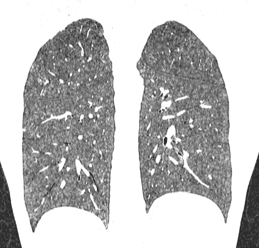 Acute hypersensitivity pneumonitis (Radiopaedia 85293-100870 Coronal lung window 97).jpg
