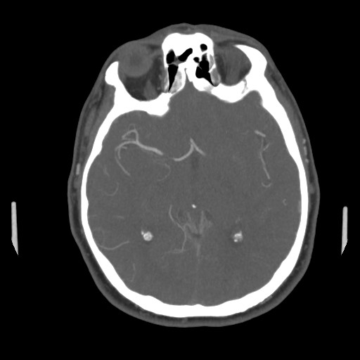 File:Acute internal carotid artery dissection (Radiopaedia 53541-59630 D 37).jpg