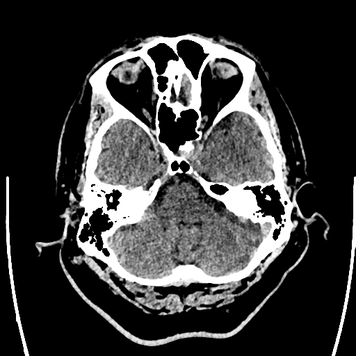 File:Acute left middle cerebral artery territory ischemic stroke (Radiopaedia 35688-37223 Axial non-contrast 16).png