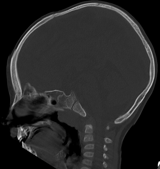 File:Acute mastoiditis (Radiopaedia 82678-96881 Sagittal bone window 33).jpg