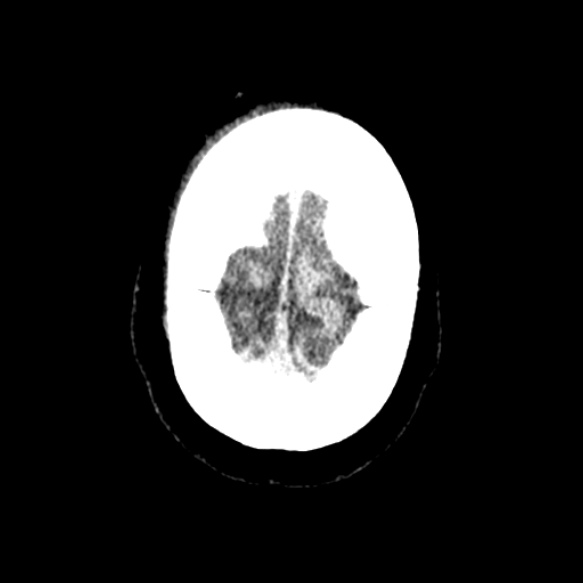 Acute middle cerebral artery territory infarct (Radiopaedia 52380-58283 Axial non-contrast 98).jpg