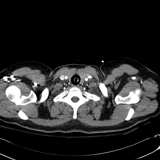 Acute myocardial infarction in CT (Radiopaedia 39947-42415 Axial C+ arterial phase 2).jpg