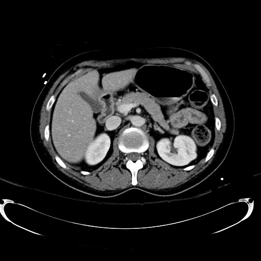 Acute myocardial infarction in CT (Radiopaedia 39947-42415 Axial C+ portal venous phase 44).jpg
