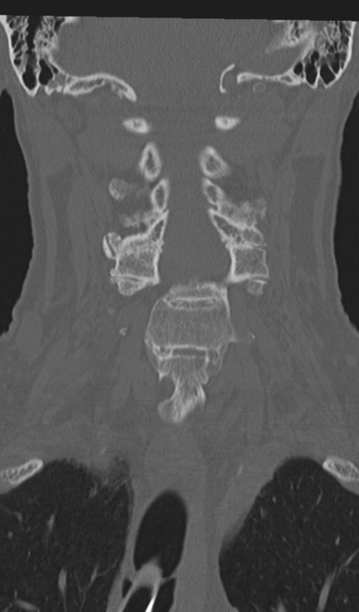 Acute on chronic subdural hematoma and thoracic vertebral injury in a multitrauma patient (Radiopaedia 31698-32619 Coronal bone window 28).jpg