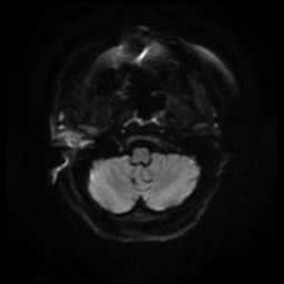 File:Acute otitis externa (Radiopaedia 57296-64236 Axial DWI 8).jpg