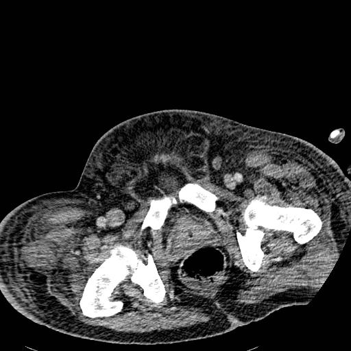 File:Acute pancreatic necrosis (Radiopaedia 13560-18501 Axial C+ portal venous phase 147).jpg