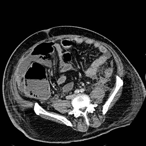 Acute pancreatic necrosis (Radiopaedia 13560-18501 Axial C+ portal venous phase 97).jpg