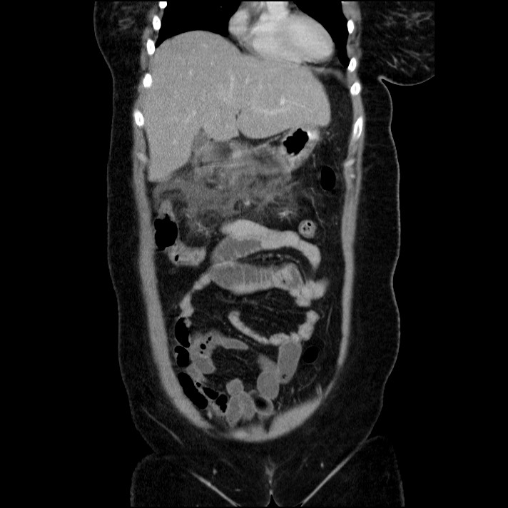 Acute pancreatitis (Radiopaedia 69236-79012 Coronal C+ portal venous phase 53).jpg