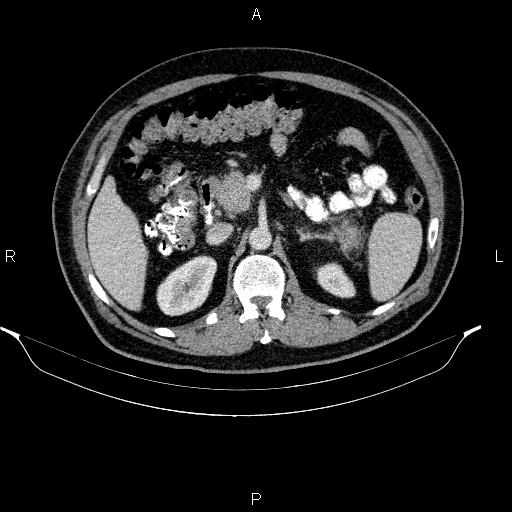File:Acute pancreatitis (Radiopaedia 85390-101010 Axial C+ portal venous phase 38).jpg