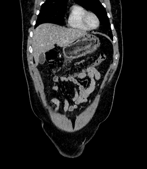 Acute pancreatitis (Radiopaedia 87428-103757 Coronal C+ portal venous phase 20).jpg