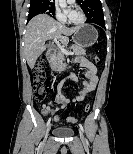 File:Acute pancreatitis (Radiopaedia 87428-103757 Coronal C+ portal venous phase 41).jpg