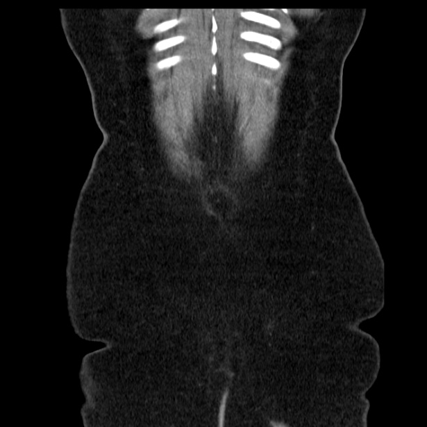 Acute pancreatitis - Balthazar C (Radiopaedia 26569-26714 Coronal C+ portal venous phase 66).jpg