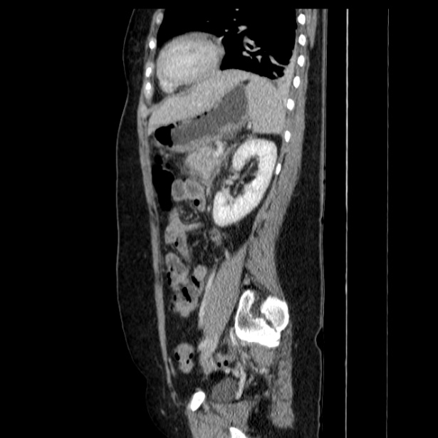 Acute pancreatitis - Balthazar C (Radiopaedia 26569-26714 Sagittal C+ portal venous phase 46).jpg