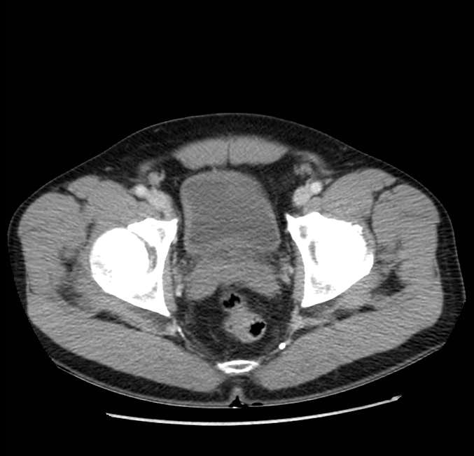 Acute pancreatitis - Balthazar E (Radiopaedia 23080-23110 Axial C+ portal venous phase 68).jpg