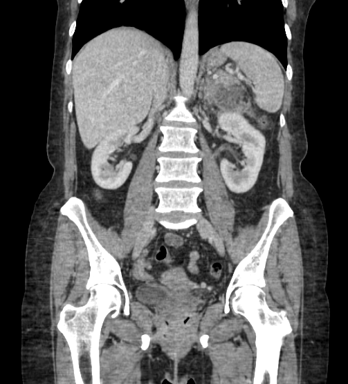 Acute pancreatitis - Balthazar E - post ERCP (Radiopaedia 27562-27772 Coronal C+ portal venous phase 50).png