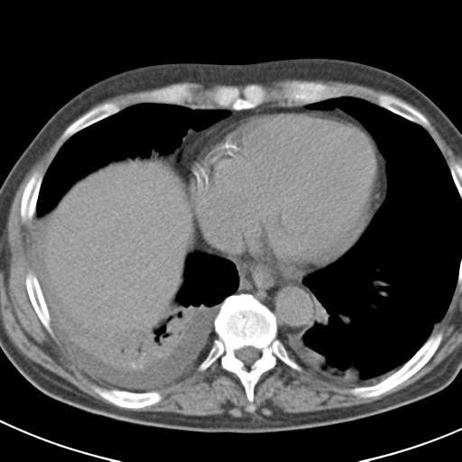 File:Acute pancreatitis and walled-off necrosis (Radiopaedia 29888-30403 Axial non-contrast 2).jpg