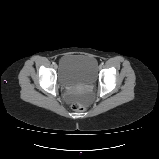 Acute pancreatitis secondary to stone at minor papilla and pancreatic divisum (Radiopaedia 76570-88333 Axial C+ portal venous phase 74).jpg