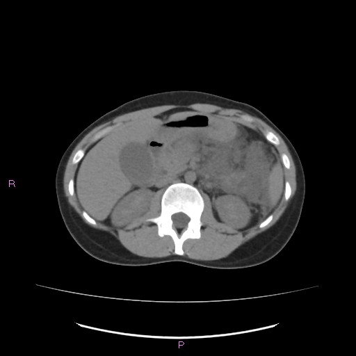 Acute pancreatitis secondary to stone at minor papilla and pancreatic divisum (Radiopaedia 76570-88333 Axial non-contrast 29).jpg