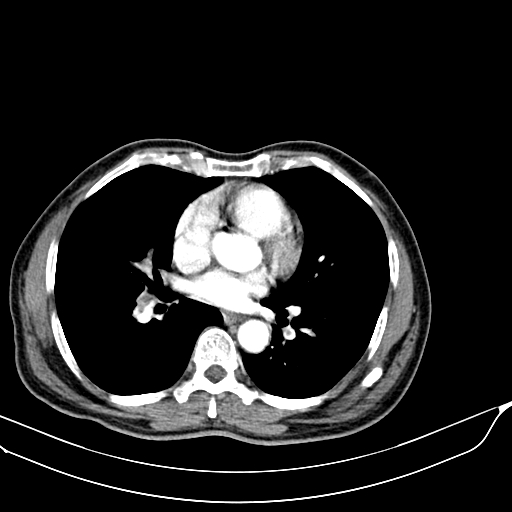 Acute pulmonary embolism (Radiopaedia 69510-79390 D 30).jpg