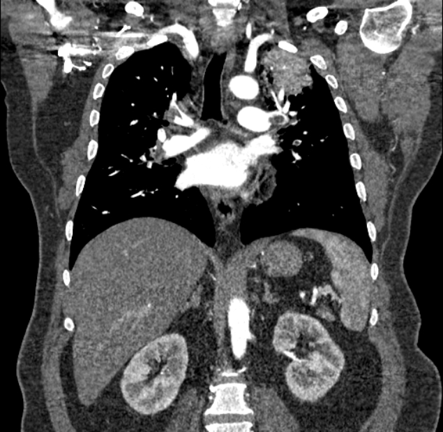 Acute pulmonary embolism with pulmonary infarcts (Radiopaedia 77688-89908 Coronal C+ CTPA 54).jpg