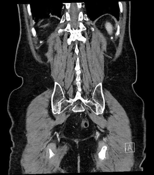 Acute renal infarction (Radiopaedia 59375-66736 Coronal C+ portal venous phase 53).jpg