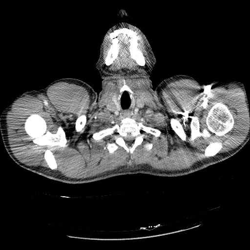 Acute segmental pulmonary emboli and pulmonary infarction (Radiopaedia 62264-70444 Axial C+ CTPA 6).jpg