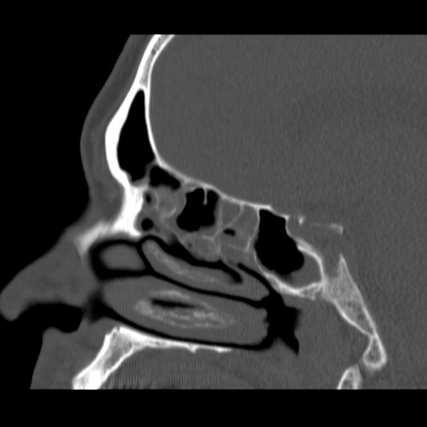 Acute sinusitis (Radiopaedia 23161-23215 Sagittal bone window 29).jpg