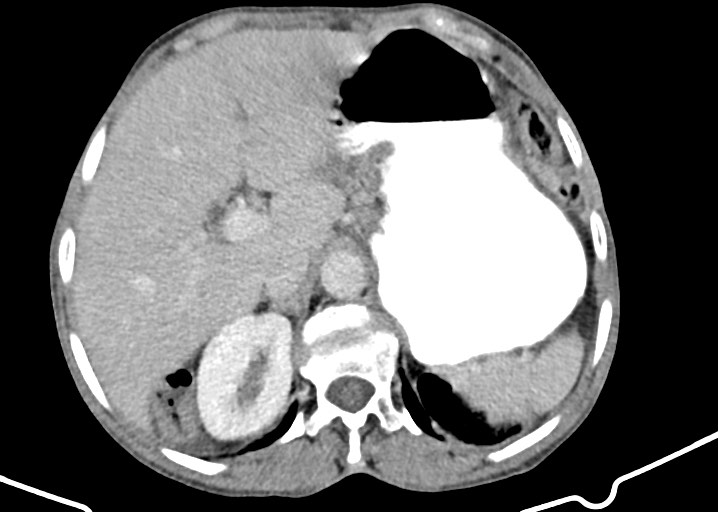 Acute small bowel (ileal) volvulus (Radiopaedia 71740-82139 Axial C+ portal venous phase 61).jpg