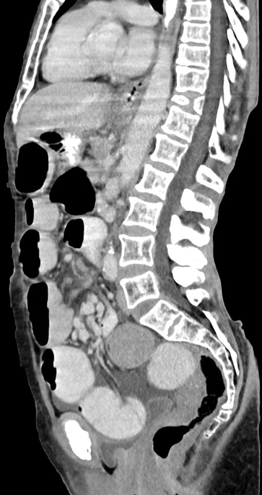 Acute small bowel (ileal) volvulus (Radiopaedia 71740-82139 Sagittal C+ portal venous phase 85).jpg