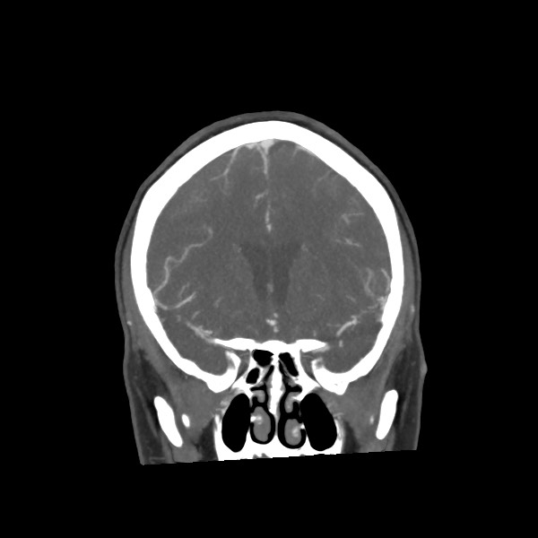 File:Acute subarachnoid hemorrhage and accessory anterior cerebral artery (Radiopaedia 69231-79009 Coronal C+ arterial phase 31).jpg