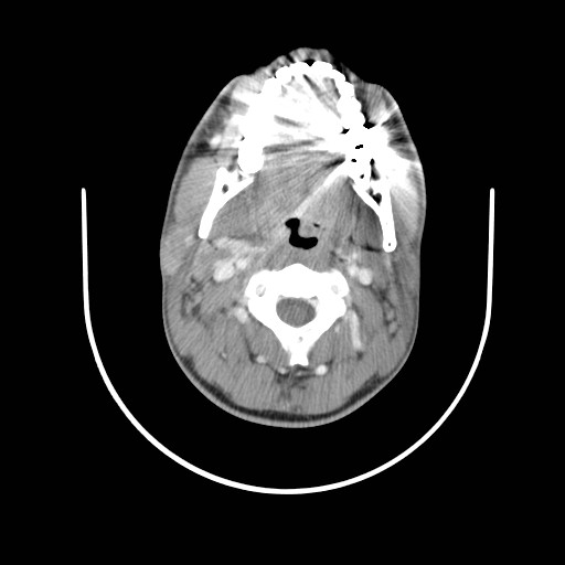 File:Acute submandibular sialadenitis secondary to ductal stone (Radiopaedia 27999-28267 Axial C+ delayed 18).jpg