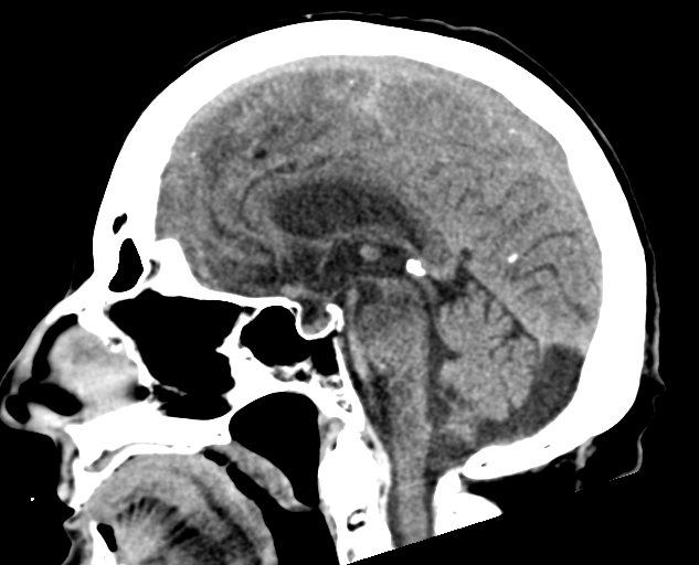 Acute traumatic subdural hematoma (Radiopaedia 82921-97257 Sagittal non-contrast 38).jpg