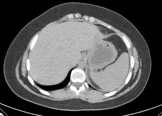 Acute unilateral nonhemorrhagic adrenal infarction (Radiopaedia 67560-76957 Axial non-contrast 6).jpg