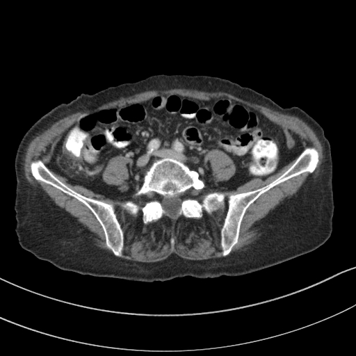 Adenocarcinoma of cecum (Radiopaedia 59222-66549 Axial C+ portal venous phase 102).jpg