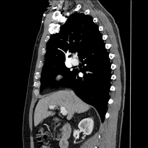 Adenocarcinoma of the lung (Radiopaedia 59871-67325 Sagittal C+ arterial phase 37).jpg