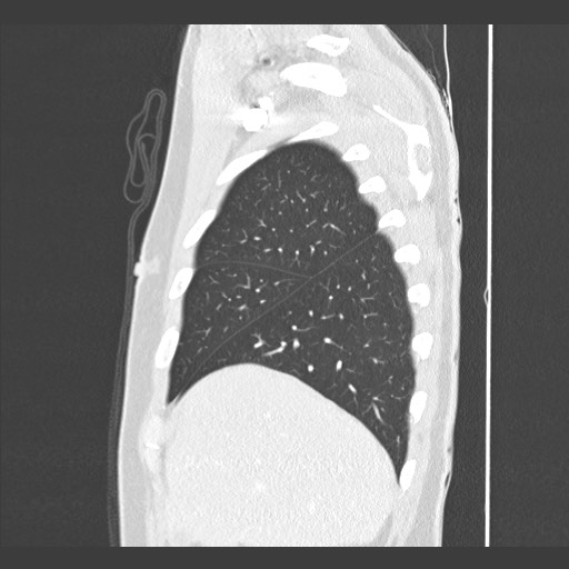 Adenocarcinoma of the lung (Radiopaedia 59871-67325 Sagittal lung window 15).jpg