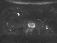 Adenocarcioma of rectum- T1 lesion (Radiopaedia 36921-38546 Axial DWI 39).png